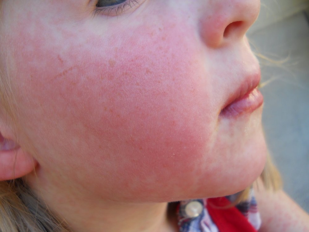 Best Essential Oils for Sunburns