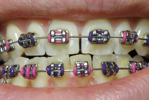 Dental Problems in Kids with Braces